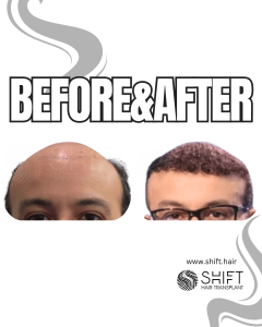 Hair Transplant Turkey Before After Norwood 7 Baldness SHIFT Hair Transplant in Istanbul 16 3