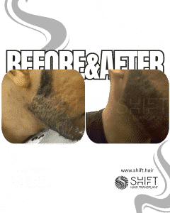 Micropigmentation for Beard Turkey Before After SHIFT Hair Transplant in Istanbul 03 3