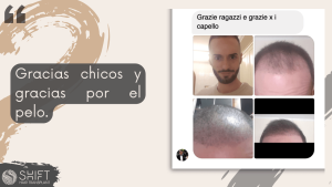 Reseña de trasplante capilar con SHIFT Hair en Turquía 10 3