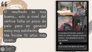 Reseña de trasplante capilar con SHIFT Hair en Turquía 22 3