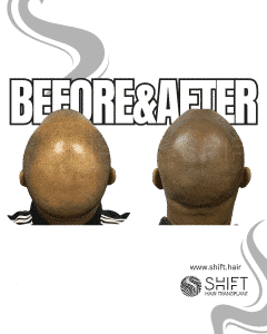 Scalp Micropigmentation for Afro Hair Turkey Before After SHIFT Hair Transplant in Istanbul 04 3