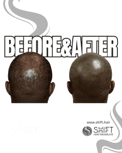 Scalp Micropigmentation for Afro Hair Turkey Before After SHIFT Hair Transplant in Istanbul 17 3