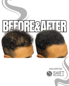 Scalp Micropigmentation for Density Camouflage Turkey Before After SHIFT Hair Transplant in Istanbul 02 3