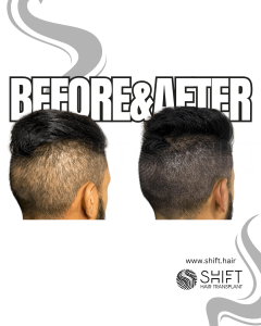 Scalp Micropigmentation for Density Camouflage Turkey Before After SHIFT Hair Transplant in Istanbul 13 3