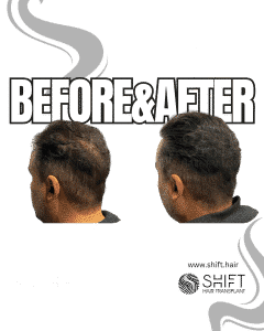 Scalp Micropigmentation for Density Camouflage Turkey Before After SHIFT Hair Transplant in Istanbul 24 3
