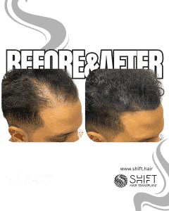 Scalp Micropigmentation for Density Camouflage Turkey Before After SHIFT Hair Transplant in Istanbul 37 3