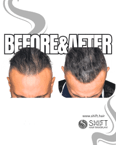 Scalp Micropigmentation for Density Camouflage Turkey Before After SHIFT Hair Transplant in Istanbul 40 3