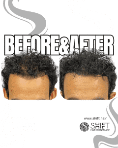Scalp Micropigmentation for Density Camouflage Turkey Before After SHIFT Hair Transplant in Istanbul 46 3