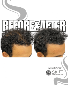Scalp Micropigmentation for Density Camouflage Turkey Before After SHIFT Hair Transplant in Istanbul 48 3