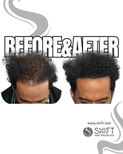 Scalp Micropigmentation for Density Camouflage Turkey Before After SHIFT Hair Transplant in Istanbul 52 3