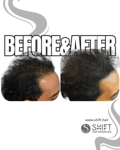 Scalp Micropigmentation for Density Camouflage Turkey Before After SHIFT Hair Transplant in Istanbul 53 3