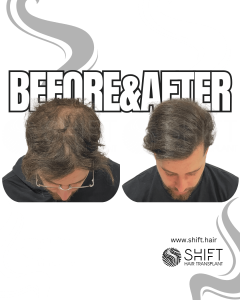 Scalp Micropigmentation for Density Camouflage Turkey Before After SHIFT Hair Transplant in Istanbul 57 3