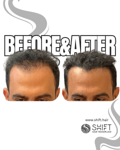 Scalp Micropigmentation for Density Camouflage Turkey Before After SHIFT Hair Transplant in Istanbul 60 3