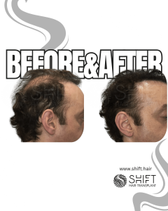 Scalp Micropigmentation for Density Camouflage Turkey Before After SHIFT Hair Transplant in Istanbul 72 3