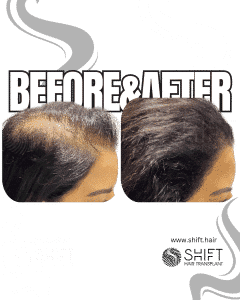 Scalp Micropigmentation for Density Camouflage for Women Turkey Before After SHIFT Hair Transplant in Istanbul 05 3