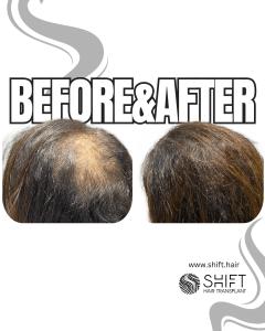 Scalp Micropigmentation for Density Camouflage for Women Turkey Before After SHIFT Hair Transplant in Istanbul 07 3