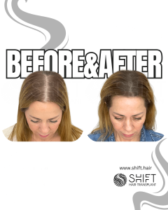 Scalp Micropigmentation for Density Camouflage for Women Turkey Before After SHIFT Hair Transplant in Istanbul 12 3