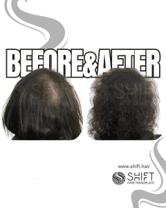 Scalp Micropigmentation for Density Camouflage for Women Turkey Before After SHIFT Hair Transplant in Istanbul 18 3
