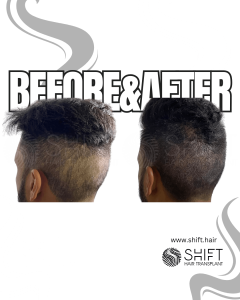 Scalp Micropigmentation for Donor Area Correct and FUT Scar Turkey Before After SHIFT Hair Transplant in Istanbul 03 3