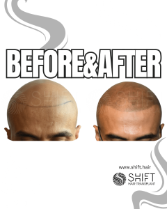 Scalp Micropigmentation for the Shaved Look Turkey Before After SHIFT Hair Transplant in Istanbul 03 3