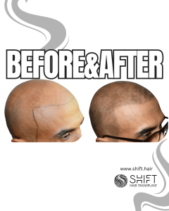 Scalp Micropigmentation for the Shaved Look Turkey Before After SHIFT Hair Transplant in Istanbul 05 3