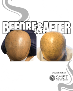 Scalp Micropigmentation for the Shaved Look Turkey Before After SHIFT Hair Transplant in Istanbul 12 3