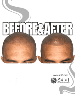 Scalp Micropigmentation for the Shaved Look Turkey Before After SHIFT Hair Transplant in Istanbul 13 3