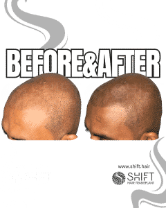 Scalp Micropigmentation for the Shaved Look Turkey Before After SHIFT Hair Transplant in Istanbul 16 3