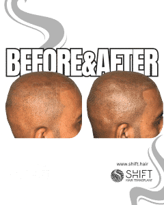 Scalp Micropigmentation for the Shaved Look Turkey Before After SHIFT Hair Transplant in Istanbul 17 3