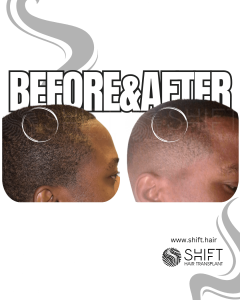 Small Area Hair Transplant Turkey Before After SHIFT Hair Transplant in Istanbul 02 3