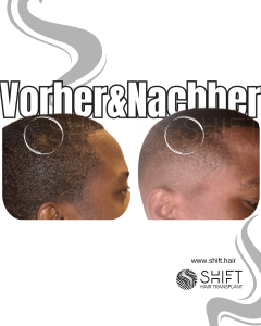Vorher Nachher einer Afro-Haartransplantation in der Türkei bei SHIFT Hair in Istanbul 23 3