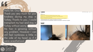 Women Hair Transplant Review with SHIFT Hair in Turkey 03 3
