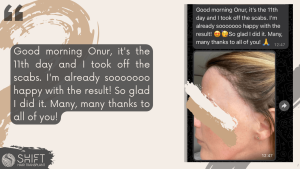 Women Hair Transplant Review with SHIFT Hair in Turkey 04 3