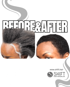 Women Hair Transplant Turkey Before After SHIFT Hair Transplant in Istanbul 03 3
