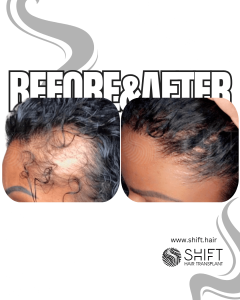 Women Hair Transplant Turkey Before After SHIFT Hair Transplant in Istanbul 06 3