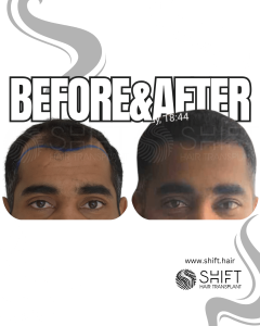 Afro Hair Transplant Turkey Before After SHIFT Hair Transplant in Istanbul 40 3