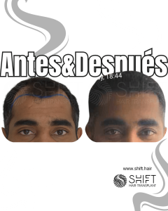 Antes Después de un trasplante de cabello afro en Turquía en SHIFT Hair en Estambul 40 3