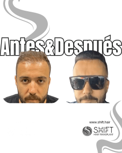 Antes Después de un trasplante de cabello de patrón femenino en Turquía en SHIFT Hair en Estambul 04 3