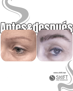 Antes Después de un trasplante de cejas en Turquía en SHIFT Hair en Estambul 25 3