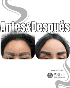 Antes Después de un trasplante de cejas en Turquía en SHIFT Hair en Estambul 28 3
