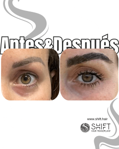Antes Después de un trasplante de cejas en Turquía en SHIFT Hair en Estambul 30 3