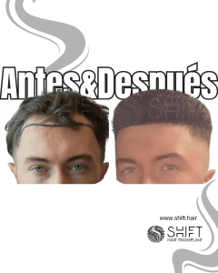 Antes y después de un trasplante capilar para la calvicie de Norwood 3 en Turquía en SHIFT Hair en Estambul 30 3