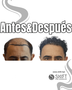Antes y después de un trasplante capilar para la calvicie de Norwood 7 en Turquía en SHIFT Hair en Estambul 22 3