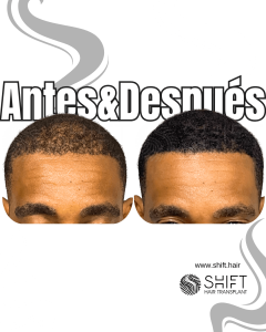 Antes y después de una micropigmentación capilar para un camuflaje de densidad en Turquía en SHIFT Hair en Estambul 77 3