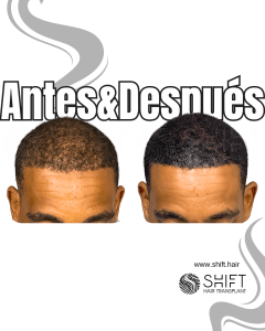 Antes y después de una micropigmentación capilar para un camuflaje de densidad en Turquía en SHIFT Hair en Estambul 78 3