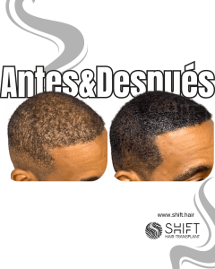 Antes y después de una micropigmentación capilar para un camuflaje de densidad en Turquía en SHIFT Hair en Estambul 80 3