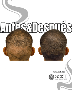 Antes y después de una micropigmentación capilar para un camuflaje de densidad en Turquía en SHIFT Hair en Estambul 83 3