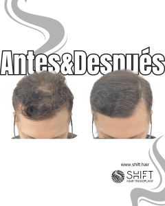 Antes y después de una micropigmentación capilar para un camuflaje de densidad en Turquía en SHIFT Hair en Estambul 84 3