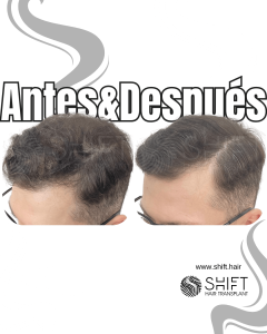 Antes y después de una micropigmentación capilar para un camuflaje de densidad en Turquía en SHIFT Hair en Estambul 86 3