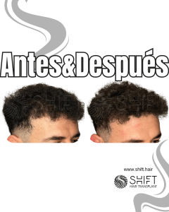 Antes y después de una micropigmentación capilar para un camuflaje de densidad en Turquía en SHIFT Hair en Estambul 87 3